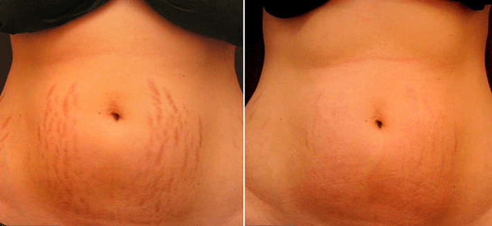 Stretch Marks Before And After Men
