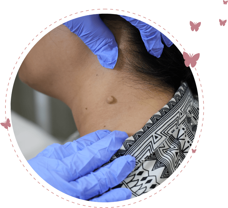 /videos/mole-removal-new-1.png