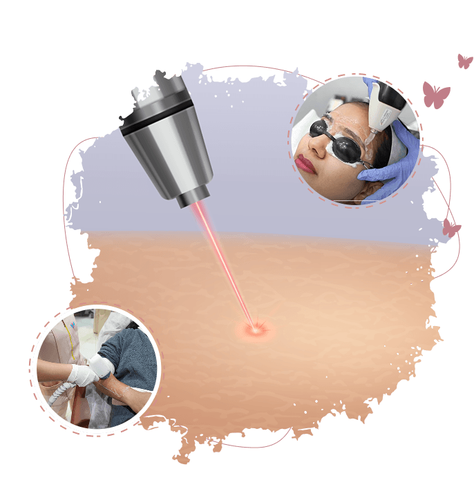 Laser Hair Removal Illustration