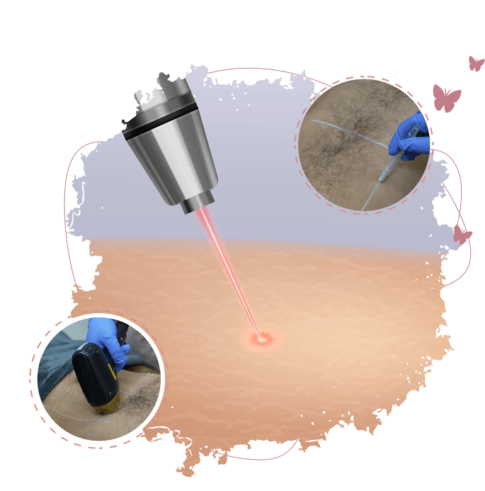 Laser Hair Removal Illustration