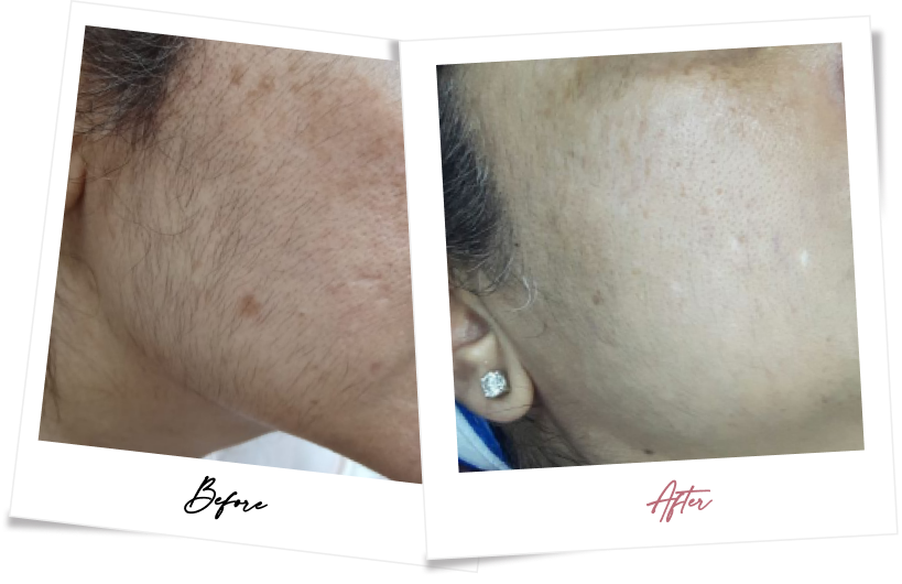 After treatment