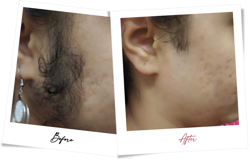 After treatment