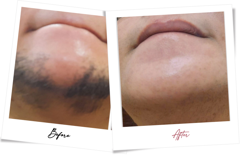 After treatment