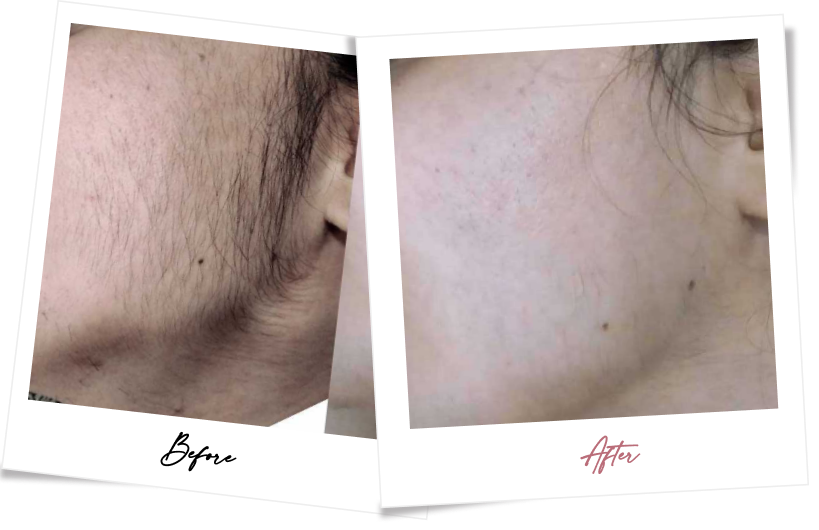 After treatment