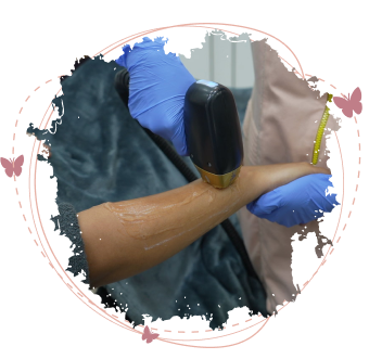 Arm laser hair removal procedure showing a person receiving laser treatment on their arm with blue gloves
