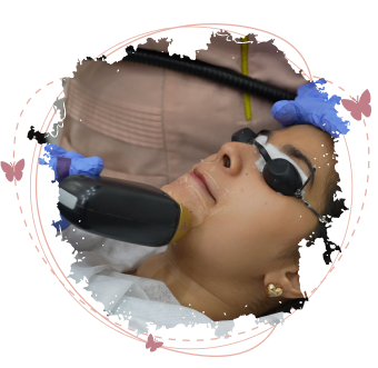 Upper lip laser hair removal showing a woman with protective eyewear receiving laser treatment on upper lip