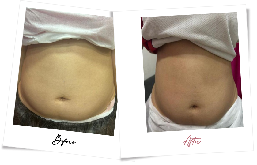 After treatment