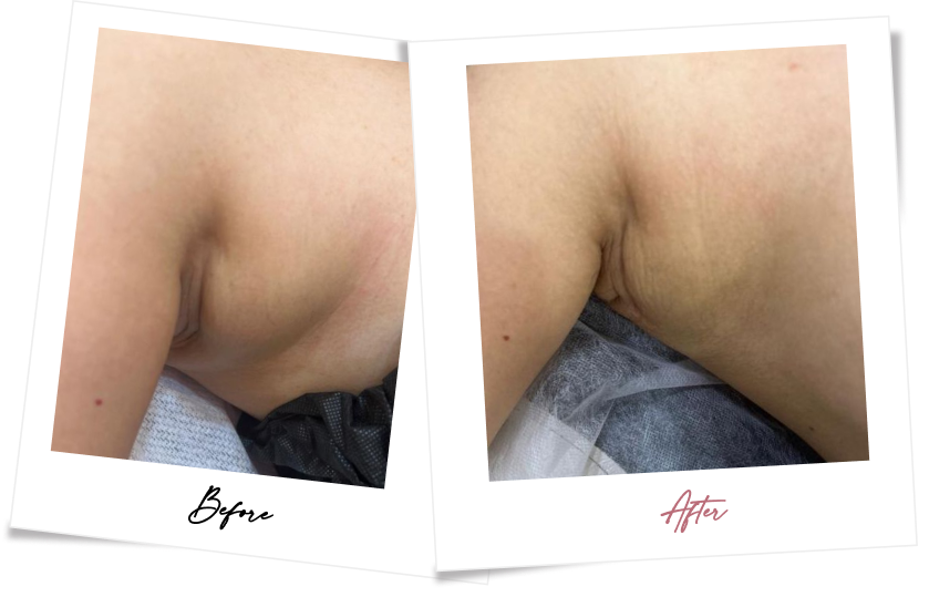 After treatment