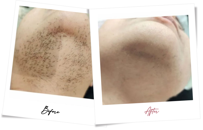 After treatment