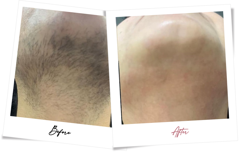 After treatment