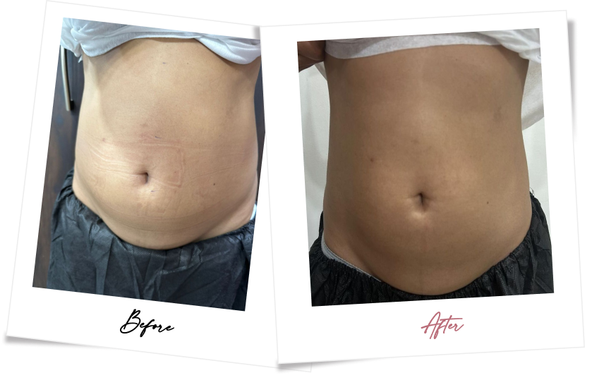 After treatment