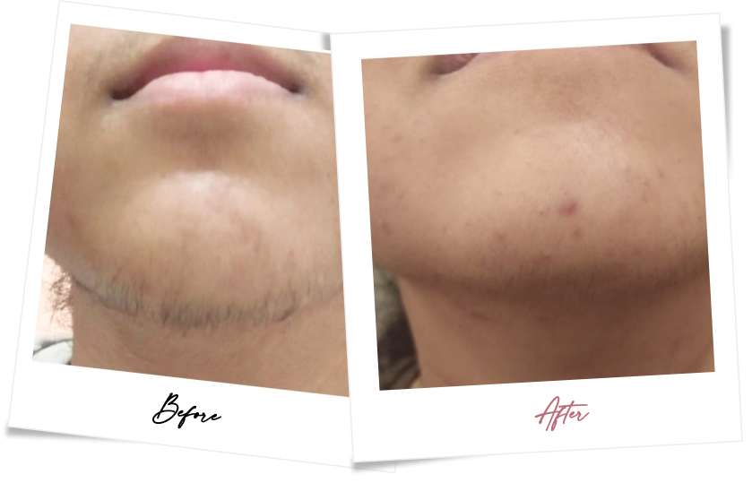 After treatment
