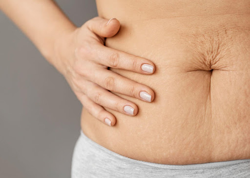 Here’s The Permanent Solution For Your Stretch Marks!