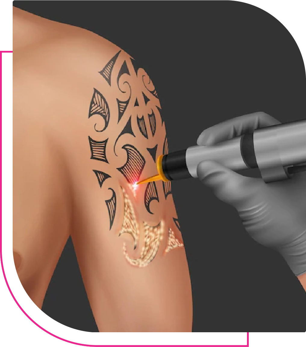 Laser Tattoo Removal vs. Dermabrasion Tattoo Removal | WIFH