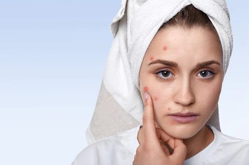 Do You Get Pimples in the Same Spot? Know the Shocking Reasons!