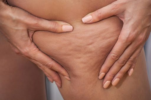 10 Things To Expect from Cellulite Reduction Treatments